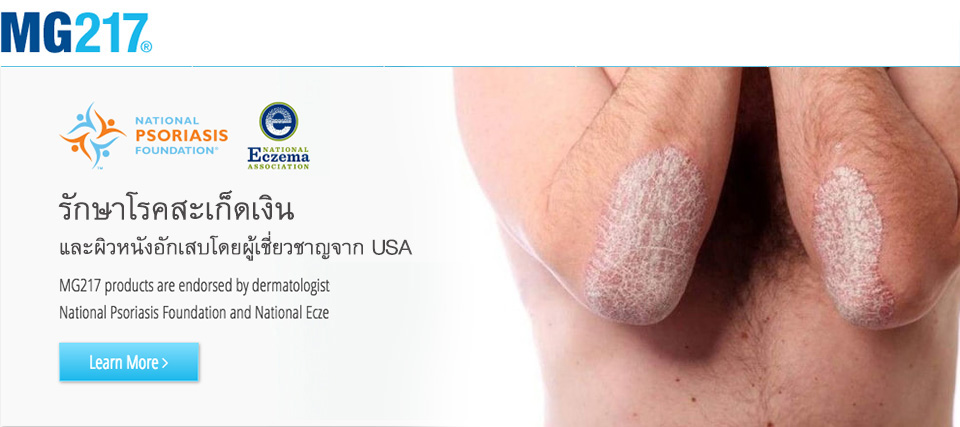 รักษาโรคสะเก็ดเงิน ใช้ครีม MG217 นำเข้าจาก USA
